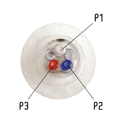 Catheter Access Buttons™ with CannuLock™