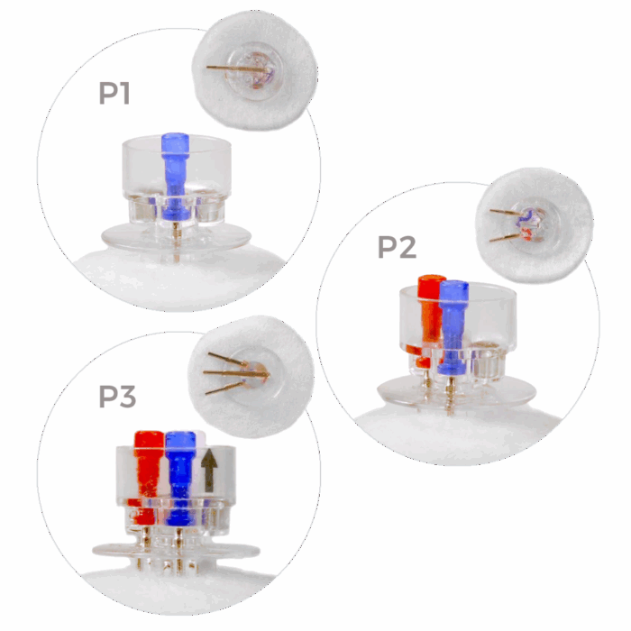 CannuLock™ Catheter Access Buttons, 22G